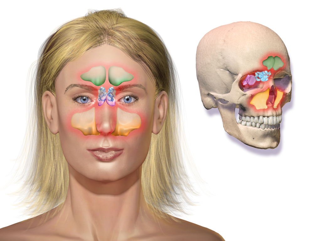 Sinusitis 鼻窦